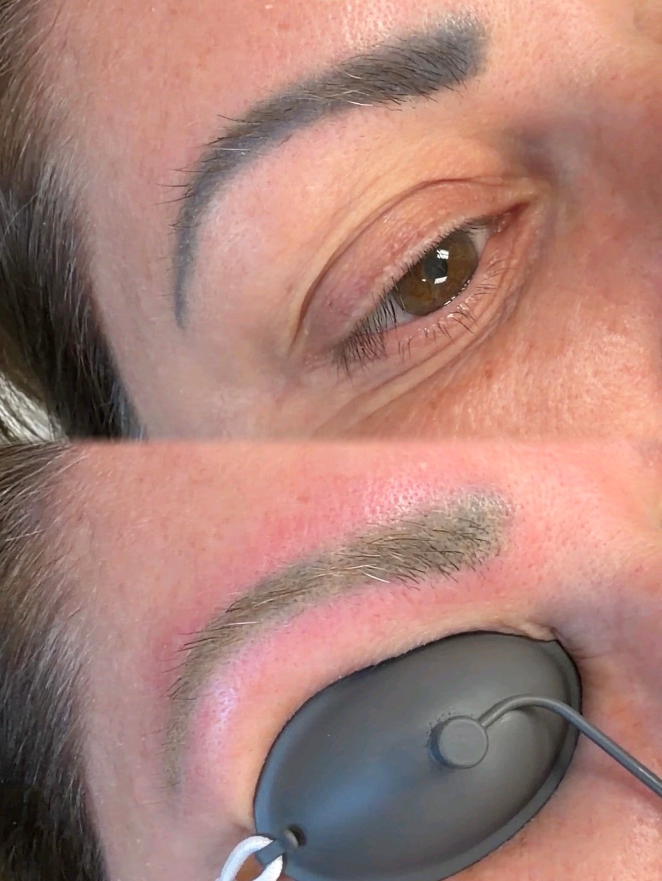 ClearLaze Pico laser melanoma treatment before and after — Bree & Co.