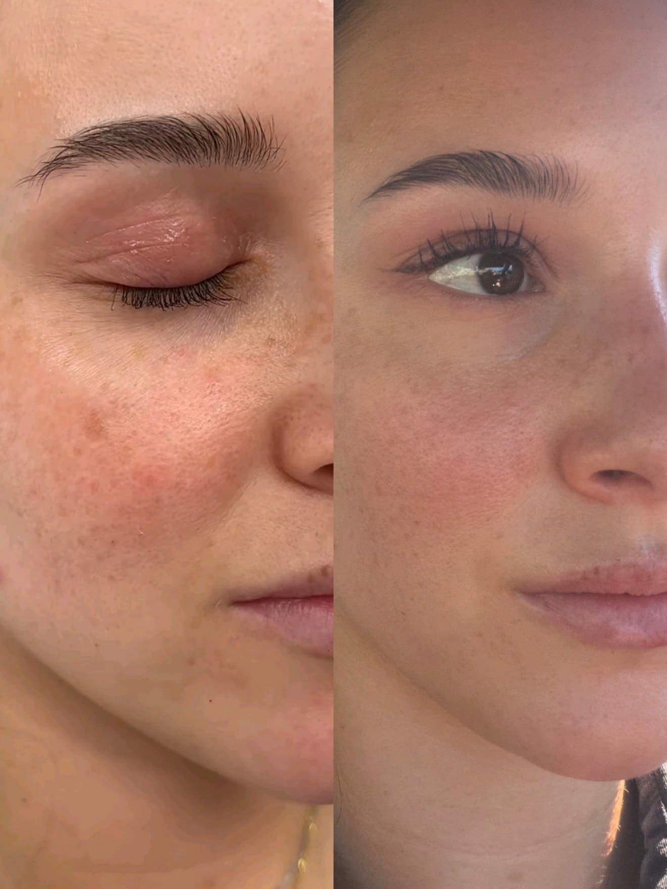 ClearLaze Pico laser melanoma treatment before and after — Bree & Co.