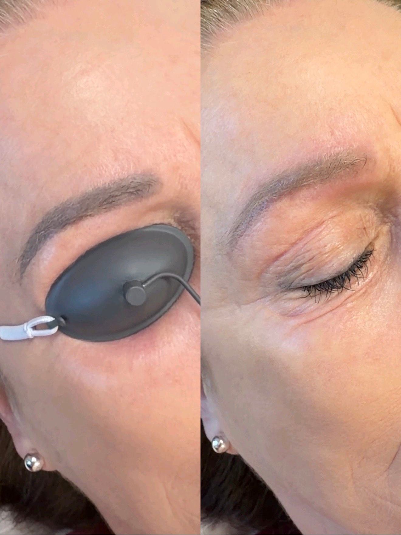 Eyelid tattoo removal before and after — Bree & Co.