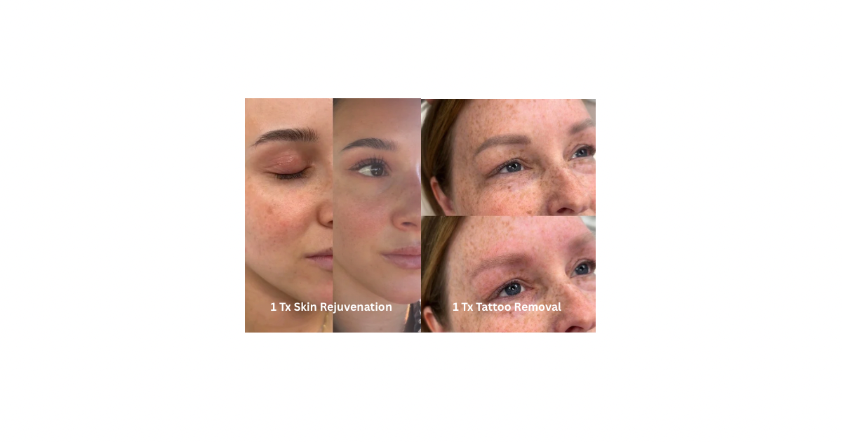ClearLaze Pico laser skin treatment — Bree & Co. Horsham PA